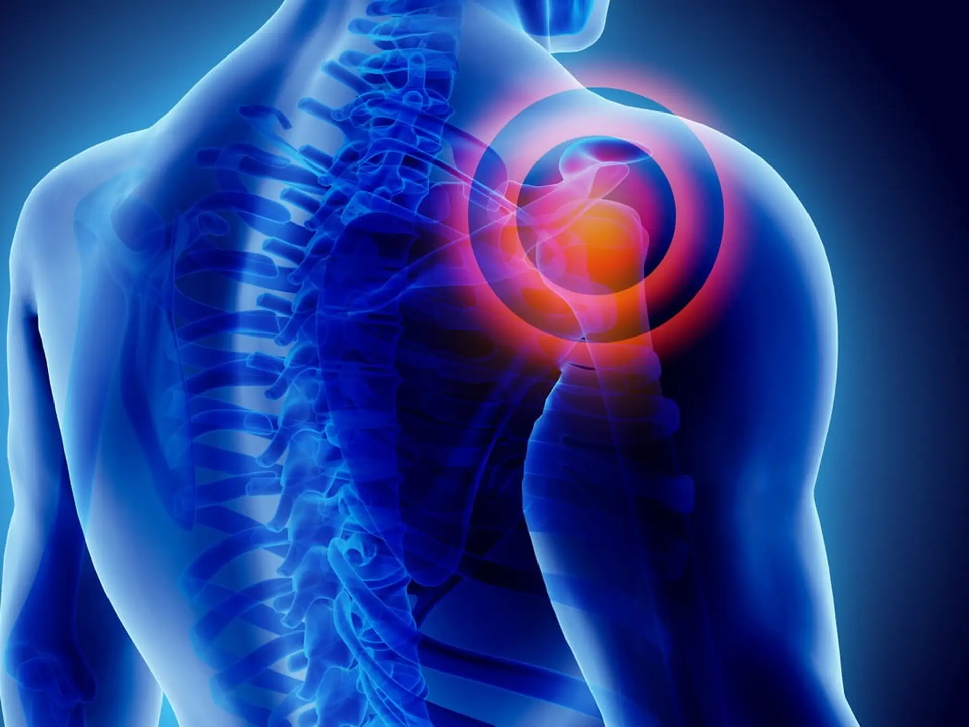 Sore muscle 3D model