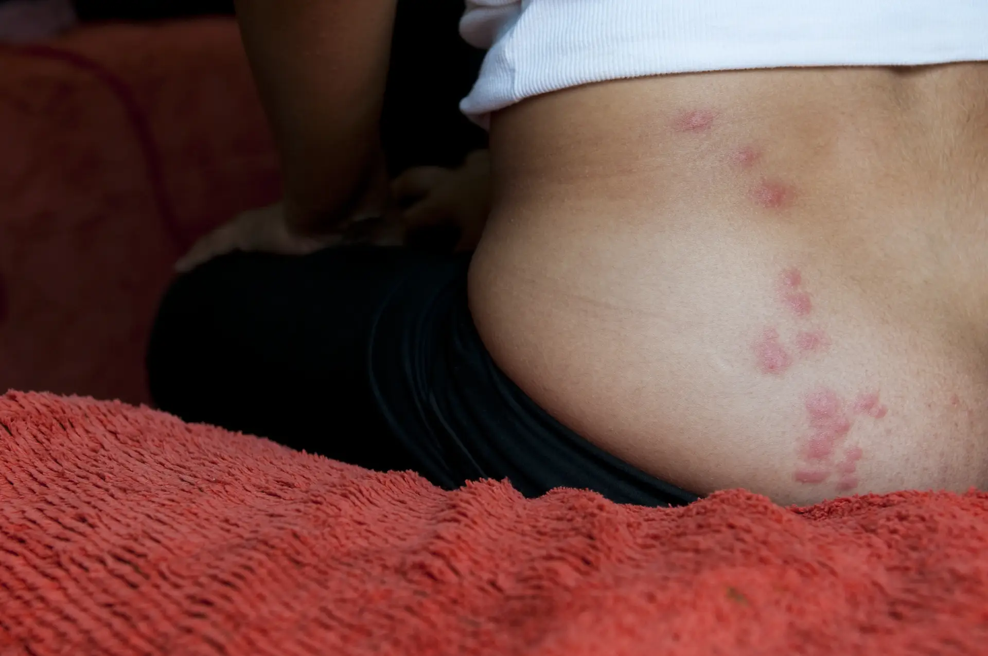 Person with red, circular rash marks on their lower back, sitting on a red textured surface.
