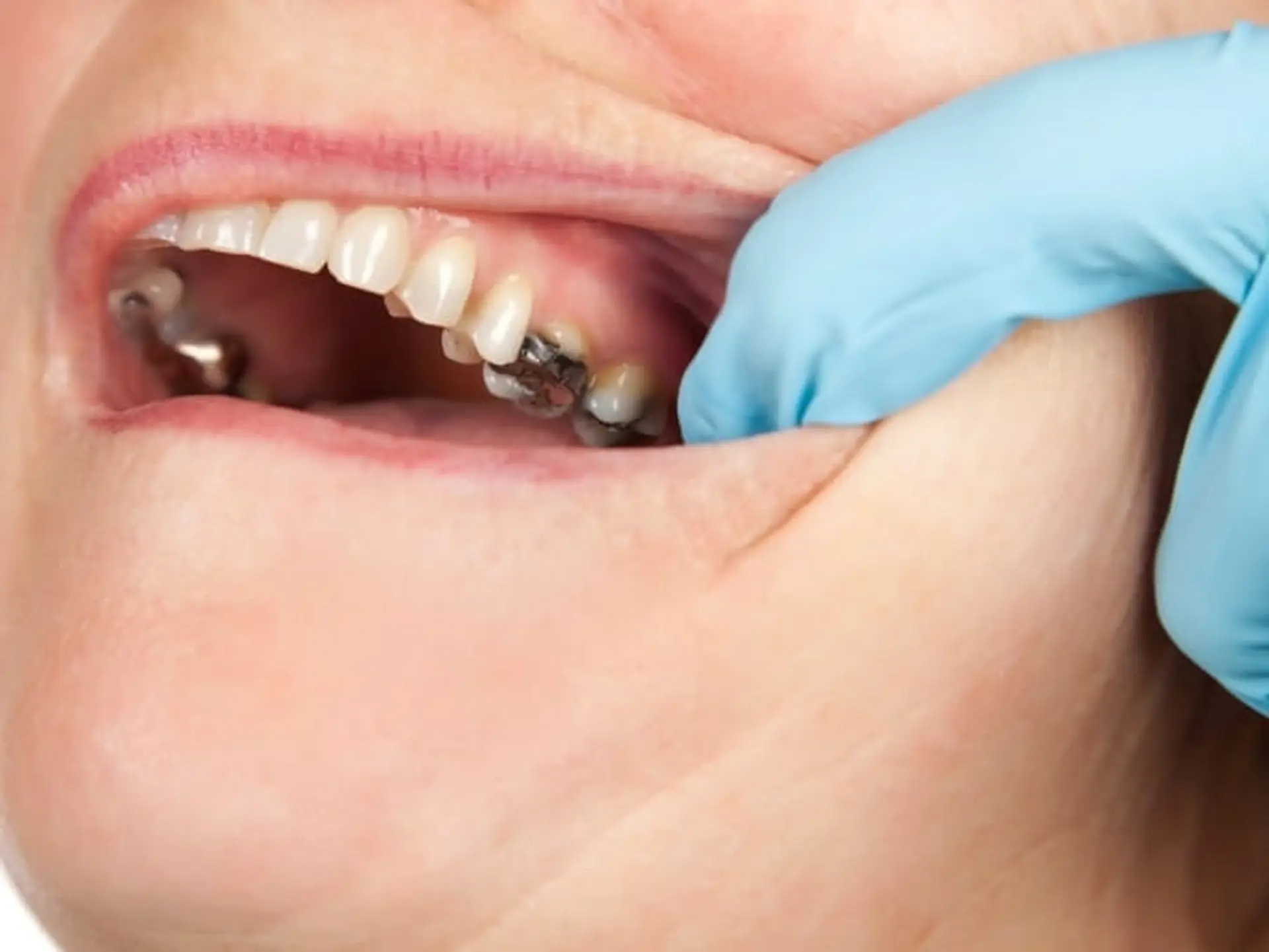 metal dental fillings